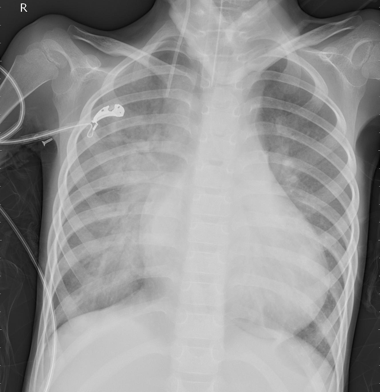 Pneumonia Classification